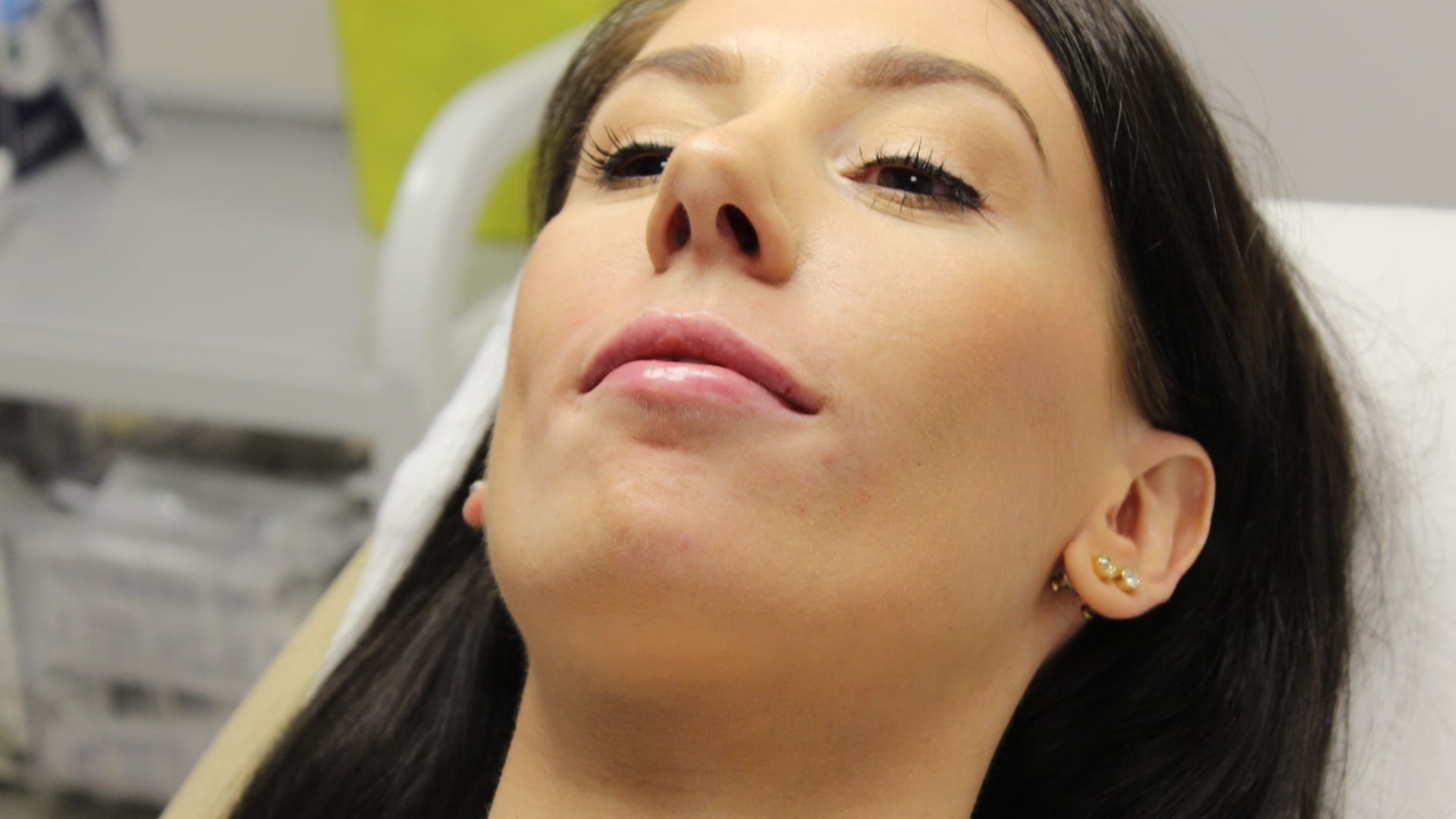 lip fillers small mouth overbite