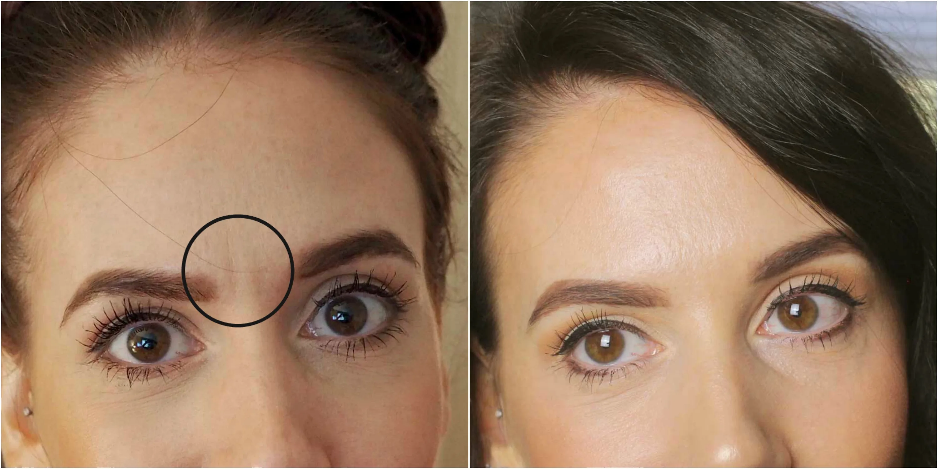 Botox for frown lines | before and after botox frown lines